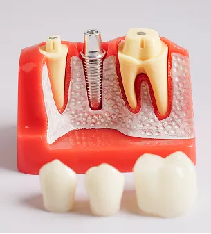 Dental Implants