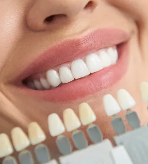 Dental Veneers