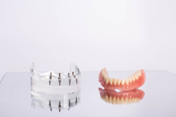 How Do All On  ® Dental Implants Work?